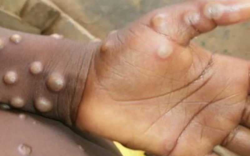 2 junio: Viruela del mono, contagios de Covid-19 y vacunación. Con Juan José Romero.