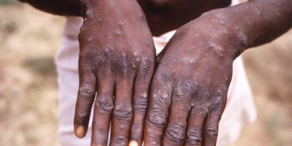 28 julio: Viruela del Mono: emergencia de salud pública de importancia internacional. Con Adriana Torres.